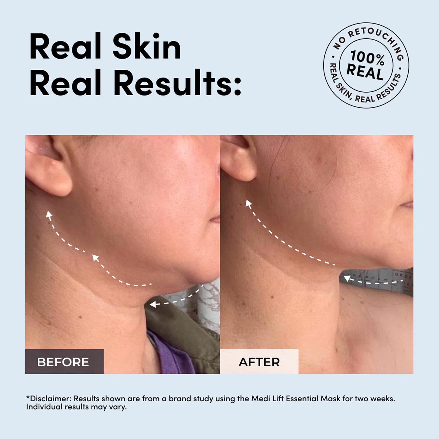 Essential Mask - Medi Lift EMS Facial Toning Device, FDA Cleared, Hands-Free Skin Device
