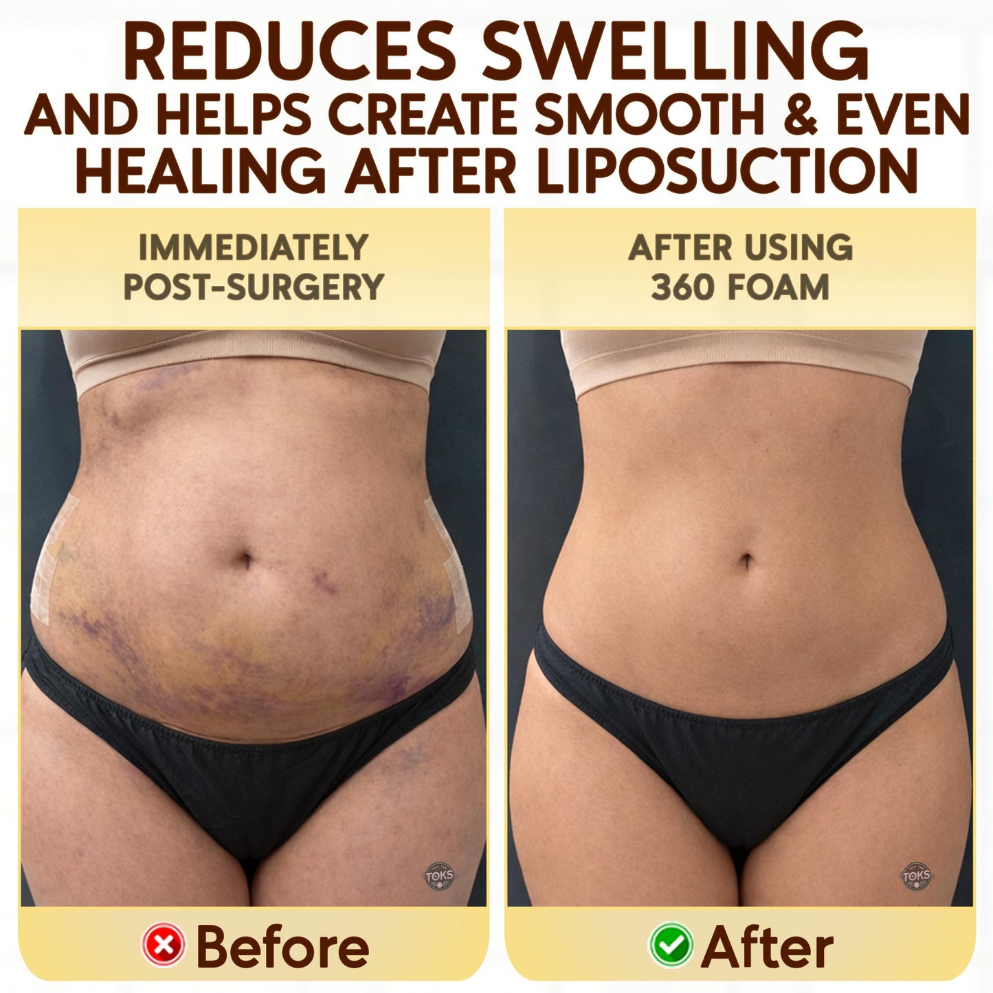Talk the Toks Post Surgery 360 Lipo Foam Wrap Around | Tummy Tuck Binder Post Surgery | Soft & Breathable Material, 360 Wrap around Liposuction | BBL Post Surgery Supplies (Small)